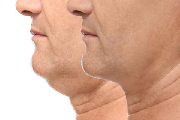 HIFU - Breakthrough in Anti - ageing 2 hifu results Stanmore
